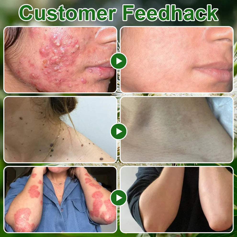 Tea Tree Oil Skin Treatment Cream✅𝐅𝐃𝐀-𝐀𝐏𝐏𝐑𝐎𝐕𝐄𝐃 – Removes Skin Blemishes, Repairs Damaged Skin, Brightens & Anti-Ageing Care